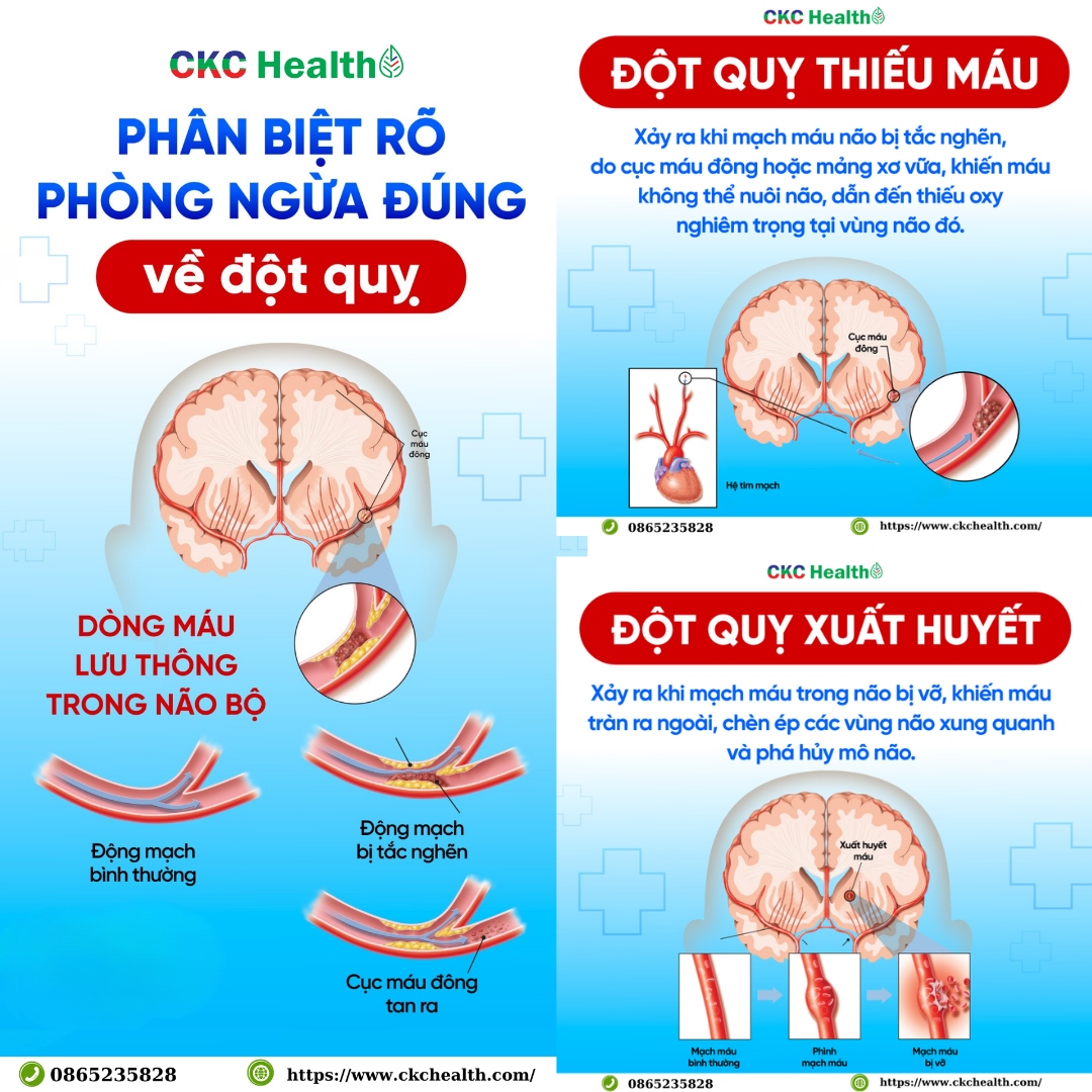 PHÂN BIỆT RÕ – PHÒNG NGỪA ĐÚNG VỀ ĐỘT QUỴ